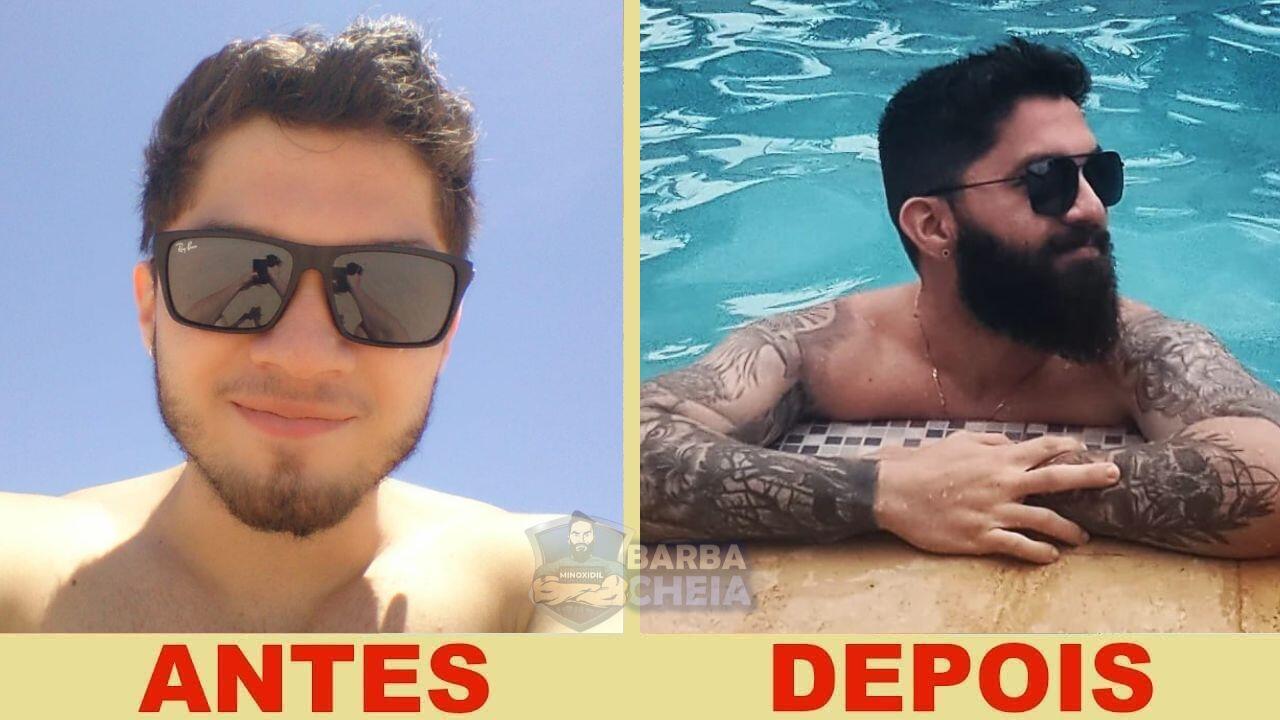 antes e depois minoxidil 01